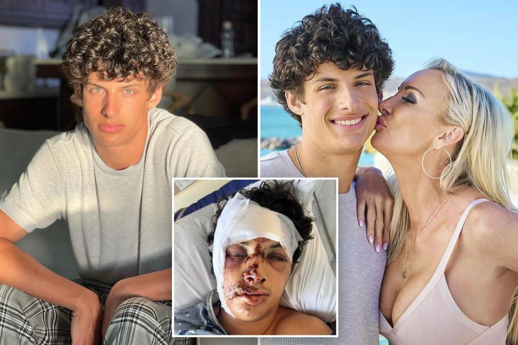 Joey Burford from ‘MILF Manor’ needs facial reconstruction surgery after horror accident