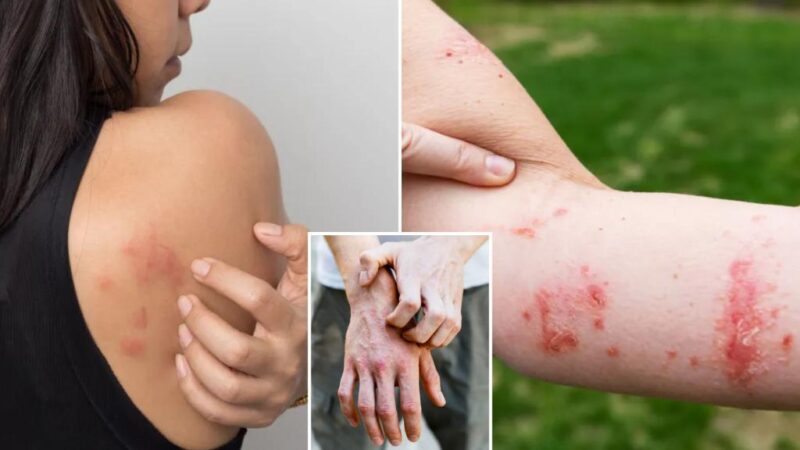 New study reveals scratching an itchy rash has some benefits