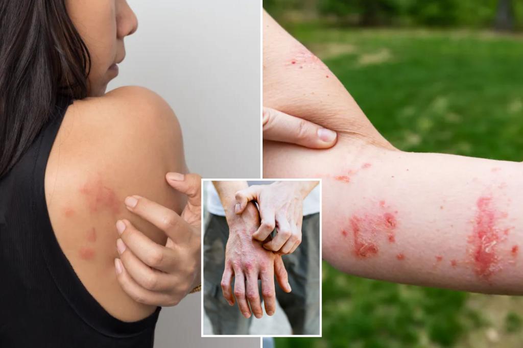 New study reveals scratching an itchy rash has some benefits