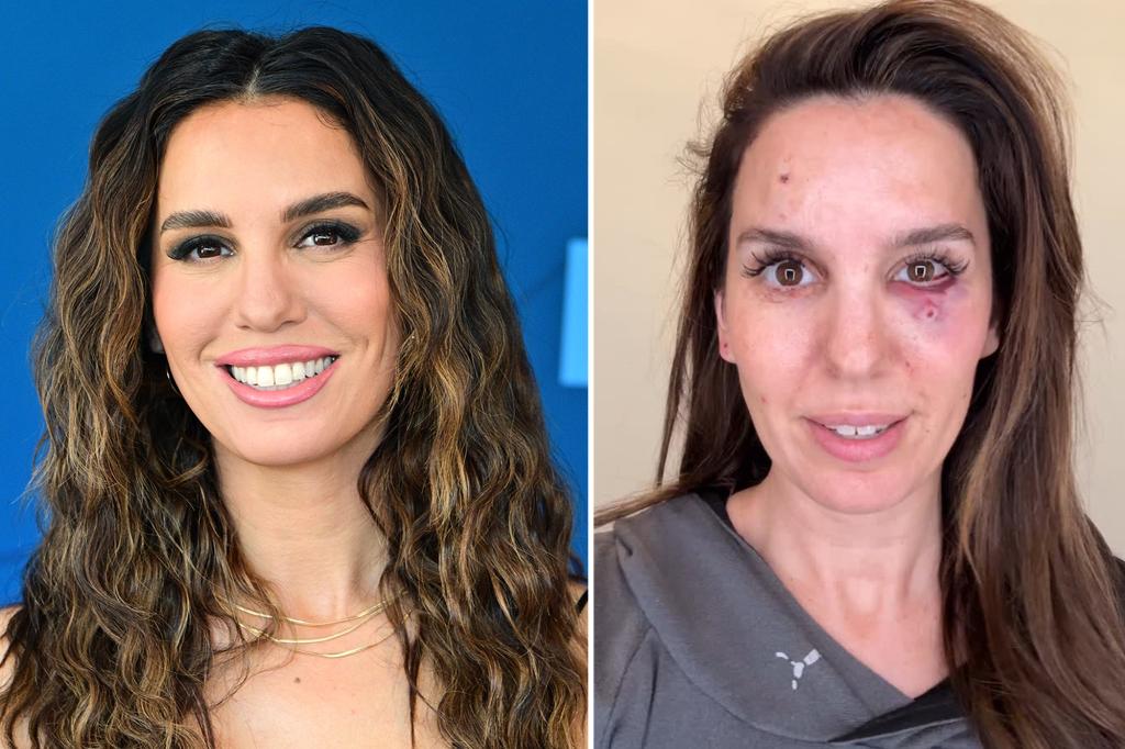 Christy Carlson Romano ‘shot in the eye’ during clay pigeon shooting outing with her husband for his birthday