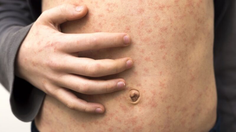 Measles outbreak continues in Texas, cases double