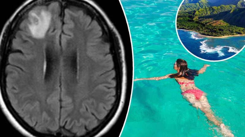 Woman, 30, infected by brain worms after trip to Hawaii