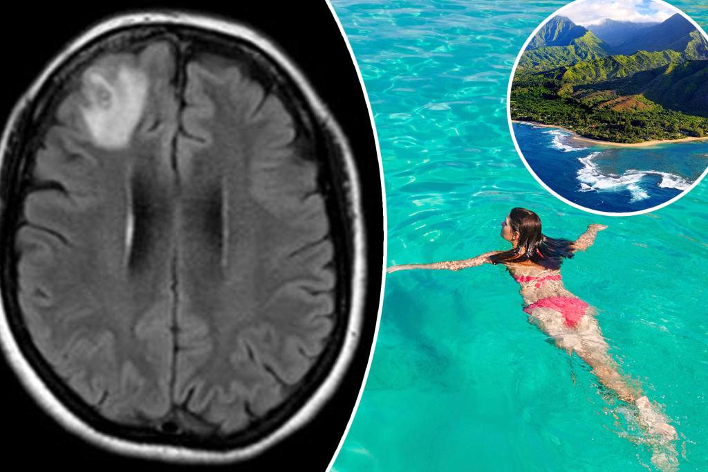 Woman, 30, infected by brain worms after trip to Hawaii