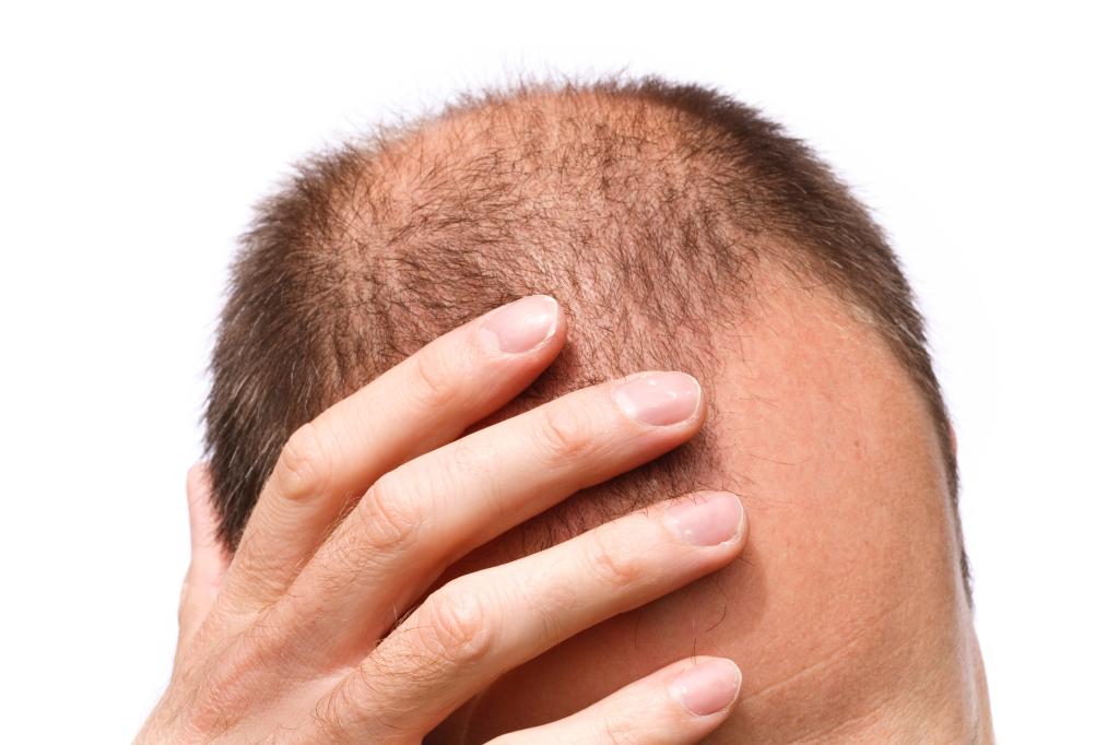 What many people don’t realize about hair transplant surgery