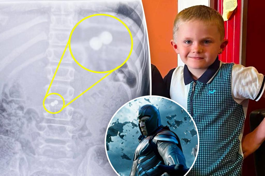 Boy swallows toy magnets, becomes X-Men’s Magneto in freak accident: ‘He burst out crying’