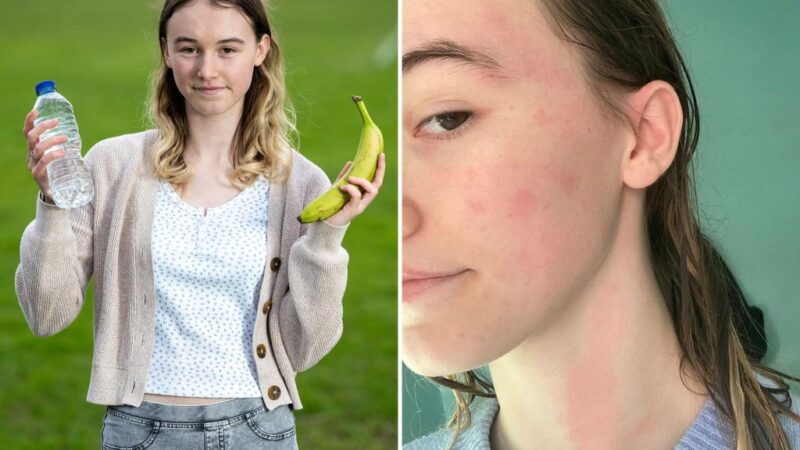 Water allergy makes me want to ‘scrape my skin off with a knife’ in the rain