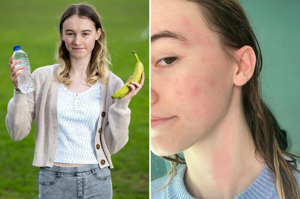 Water allergy makes me want to ‘scrape my skin off with a knife’ in the rain